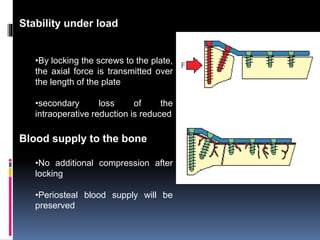 Stability under load
•By locking the screws to the plate,
the axial force is transmitted over
the length of the plate
•sec...