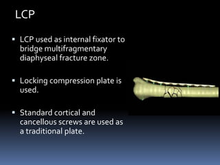  LCP used as internal fixator to
bridge multifragmentary
diaphyseal fracture zone.
 Locking compression plate is
used.
...