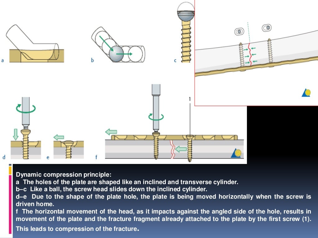 Plates and screws 11