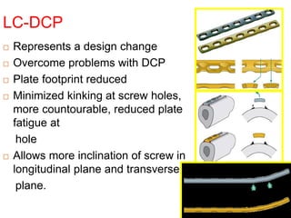 LC-DCP
 Represents a design change
 Overcome problems with DCP
 Plate footprint reduced
 Minimized kinking at screw holes,
more countourable, reduced plate
fatigue at
hole
 Allows more inclination of screw in
longitudinal plane and transverse
plane.
 