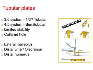 Tubular plates
 3.5 system - 1/3rd Tubular
 4.5 system - Semitubular
 Limited stability
 Collared hole
 Lateral malleolus
 Distal ulna / Olecranon
 Distal humerus
 