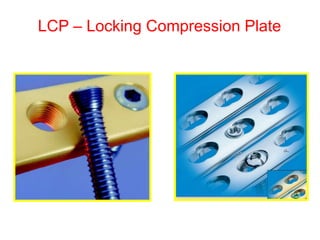 LCP – Locking Compression Plate
 