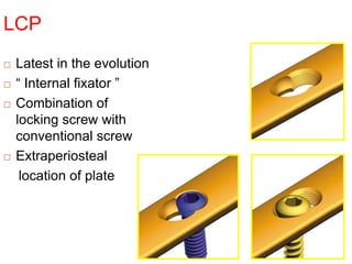 LCP
 Latest in the evolution
 “ Internal fixator ”
 Combination of
locking screw with
conventional screw
 Extraperiosteal
location of plate
 