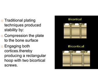  Traditional plating
techniques produced
stability by:
 Compression the plate
to the bone surface
 Engaging both
cortices.thereby
producing a rectangular
hoop with two bicortical
screws.
 