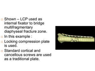  Shown – LCP used as
internal fixator to bridge
multifragmentary
diaphyseal fracture zone.
 In this example :
 Locking compression plate
is used.
 Standard cortical and
cancellous screws are used
as a traditional plate.
 