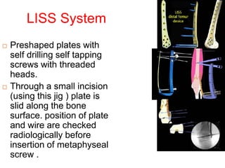 LISS System
 Preshaped plates with
self drilling self tapping
screws with threaded
heads.
 Through a small incision
(using this jig ) plate is
slid along the bone
surface. position of plate
and wire are checked
radiologically before
insertion of metaphyseal
screw .
 
