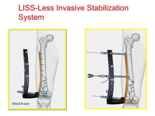 LISS-Less Invasive Stabilization
System
 