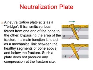 Neutralization Plate
 A neutralization plate acts as a
""bridge". It transmits various
forces from one end of the bone to
the other, bypassing the area of the
fracture. Its main function is to act
as a mechanical link between the
healthy segments of bone above
and below the fracture. Such a
plate does not produce any
compression at the fracture site.
 