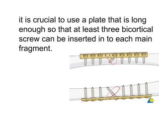 it is crucial to use a plate that is long
enough so that at least three bicortical
screw can be inserted in to each main
fragment.
 