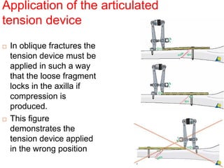 Application of the articulated
tension device
 In oblique fractures the
tension device must be
applied in such a way
that the loose fragment
locks in the axilla if
compression is
produced.
 This figure
demonstrates the
tension device applied
in the wrong position
 