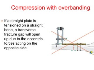 Compression with overbanding
 If a straight plate is
tensioned on a straight
bone, a transverse
fracture gap will open
up due to the eccentric
forces acting on the
opposite side.
 