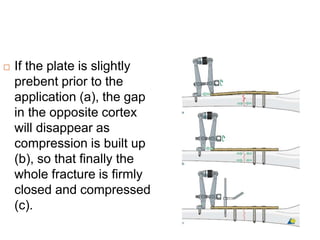  If the plate is slightly
prebent prior to the
application (a), the gap
in the opposite cortex
will disappear as
compression is built up
(b), so that finally the
whole fracture is firmly
closed and compressed
(c).
 