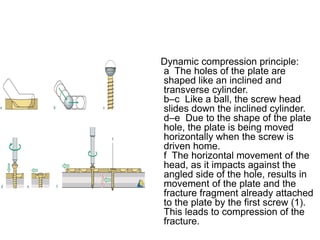 Dynamic compression principle:
a The holes of the plate are
shaped like an inclined and
transverse cylinder.
b–c Like a ball, the screw head
slides down the inclined cylinder.
d–e Due to the shape of the plate
hole, the plate is being moved
horizontally when the screw is
driven home.
f The horizontal movement of the
head, as it impacts against the
angled side of the hole, results in
movement of the plate and the
fracture fragment already attached
to the plate by the first screw (1).
This leads to compression of the
fracture.
 