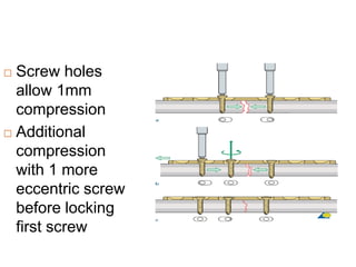  Screw holes
allow 1mm
compression
 Additional
compression
with 1 more
eccentric screw
before locking
first screw
 