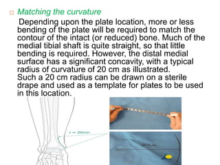  Matching the curvature
Depending upon the plate location, more or less
bending of the plate will be required to match the
contour of the intact (or reduced) bone. Much of the
medial tibial shaft is quite straight, so that little
bending is required. However, the distal medial
surface has a significant concavity, with a typical
radius of curvature of 20 cm as illustrated.
Such a 20 cm radius can be drawn on a sterile
drape and used as a template for plates to be used
in this location.
 