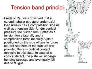 Tension band principle
 Frederic Pauwels observed that a
curved, tubular structure under axial
load always has a compression side as
well as a tension side. Under vertical
pressure the curved femur creates a
tension force laterally and a
compression force medially A plate
positioned on the side of tensile forces
neutralizes them at the fracture site
provided there is cortical contact
opposite to this plate. In case of a
cortical defect, the plate will undergo
bending stresses and eventually fail
due to fatigue.
 