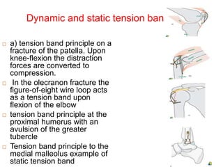 Dynamic and static tension band
 a) tension band principle on a
fracture of the patella. Upon
knee-flexion the distraction
forces are converted to
compression.
 In the olecranon fracture the
figure-of-eight wire loop acts
as a tension band upon
flexion of the elbow
 tension band principle at the
proximal humerus with an
avulsion of the greater
tubercle
 Tension band principle to the
medial malleolus example of
static tension band
 
