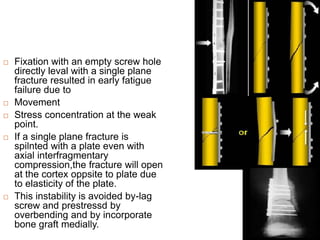  Fixation with an empty screw hole
directly leval with a single plane
fracture resulted in early fatigue
failure due to
 Movement
 Stress concentration at the weak
point.
 If a single plane fracture is
spilnted with a plate even with
axial interfragmentary
compression,the fracture will open
at the cortex oppsite to plate due
to elasticity of the plate.
 This instability is avoided by-lag
screw and prestressd by
overbending and by incorporate
bone graft medially.
 