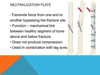 NEUTRALIZATION PLATE
• Transmits force from one end to
another bypassing the fracture site
• Function – mechanical link
between healthy segment of bone
above and below fracture
• Does not produce compression
• Used In combination with lag screw
 
