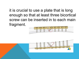 it is crucial to use a plate that is long
enough so that at least three bicortical
screw can be inserted in to each main
fragment.
 