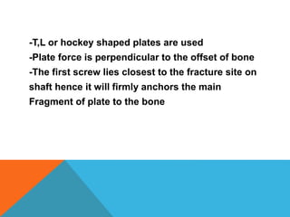 -T,L or hockey shaped plates are used
-Plate force is perpendicular to the offset of bone
-The first screw lies closest to the fracture site on
shaft hence it will firmly anchors the main
Fragment of plate to the bone
 