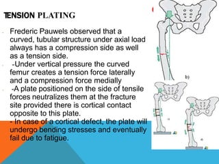 TENSION PLATING
e
- Frederic Pauwels observed that a
curved, tubular structure under axial load
always has a compression side as well
as a tension side.
- -Under vertical pressure the curved
femur creates a tension force laterally
and a compression force medially
- -A plate positioned on the side of tensile
forces neutralizes them at the fracture
site provided there is cortical contact
opposite to this plate.
- - In case of a cortical defect, the plate will
undergo bending stresses and eventually
fail due to fatigue.
 