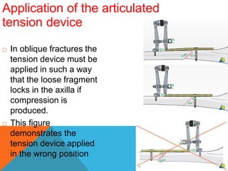 Application of the articulated
tension device
 In oblique fractures the
tension device must be
applied in such a way
that the loose fragment
locks in the axilla if
compression is
produced.
 This figure
demonstrates the
tension device applied
in the wrong position
 