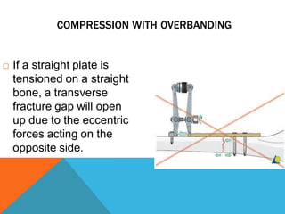 COMPRESSION WITH OVERBANDING
 If a straight plate is
tensioned on a straight
bone, a transverse
fracture gap will open
up due to the eccentric
forces acting on the
opposite side.
 