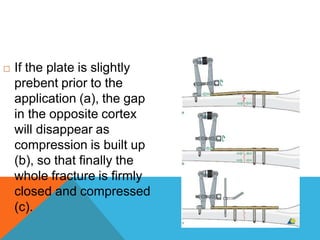  If the plate is slightly
prebent prior to the
application (a), the gap
in the opposite cortex
will disappear as
compression is built up
(b), so that finally the
whole fracture is firmly
closed and compressed
(c).
 
