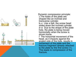 Dynamic compression principle:
a.The holes of the plate are
shaped like an inclined and
transverse cylinder.
b–c Like a ball, the screw head
slides down the inclined cylinder.
d–e Due to the shape of the plate
hole, the plate is being moved
horizontally when the screw is
driven home.
f The horizontal movement of the
head, as it impacts against the
angled side of the hole, results in
movement of the plate and the
fracture fragment already attached
to the plate by the first screw (1).
This leads to compression of the
fracture.
 