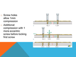  Screw holes
allow 1mm
compression
 Additional
compression with 1
more eccentric
screw before locking
first screw
 