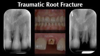 Traumatic Root Fracture