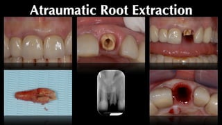 Atraumatic Root Extraction