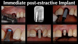 Immediate post-estractive Implant