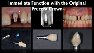 Immediate Function with the Original
Procera Crown