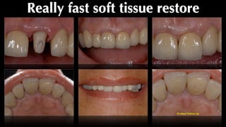 Really fast soft tissue restore
15 days Follow Up