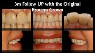 3m Follow UP with the Original
Procera Crown