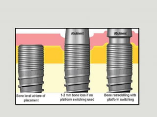 platform switching in implants power point presentation | PPTX