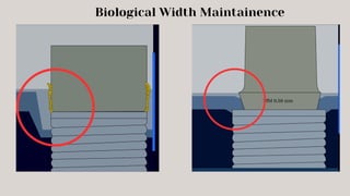 Biological Width Maintainence
 
