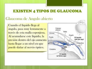 Glaucoma de Angulo abierto
EXISTEN 4 TIPOS DE GLAUCOMA
Cuando el líquido llega al
ángulo, pasa muy lentamente a
través de esta malla esponjosa.
Al acumularse este líquido, la
presión dentro del ojo aumenta
hasta llegar a un nivel en que
puede dañar al nervio óptico.
 