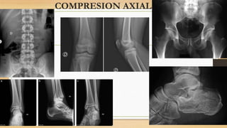 COMPRESION AXIAL
 