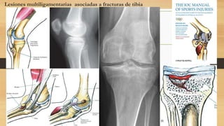 Lesiones multiligamentarias asociadas a fracturas de tibia
 