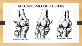 MECANISMO DE LESION
 