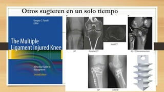 Otros sugieren en un solo tiempo
 