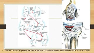 • TERRY CANEL & JAMES BEATY. CAMPBELL'S OPERATIVE ORTHOPAEDICS. 11TH ED. 2008.
 