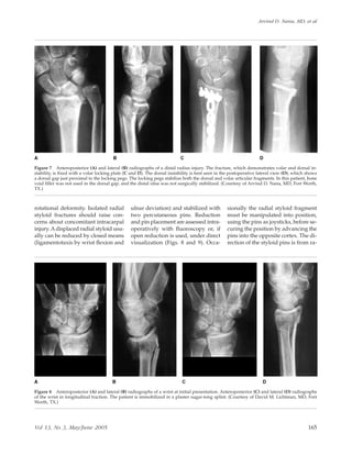 rotational deformity. Isolated radial
styloid fractures should raise con-
cerns about concomitant intracarpal
injury. Adisplaced radial styloid usu-
ally can be reduced by closed means
(ligamentotaxis by wrist ﬂexion and
ulnar deviation) and stabilized with
two percutaneous pins. Reduction
and pin placement are assessed intra-
operatively with ﬂuoroscopy or, if
open reduction is used, under direct
visualization (Figs. 8 and 9). Occa-
sionally the radial styloid fragment
must be manipulated into position,
using the pins as joysticks, before se-
curing the position by advancing the
pins into the opposite cortex. The di-
rection of the styloid pins is from ra-
Figure 7 Anteroposterior (A) and lateral (B) radiographs of a distal radius injury. The fracture, which demonstrates volar and dorsal in-
stability, is ﬁxed with a volar locking plate (C and D). The dorsal instability is best seen in the postoperative lateral view (D), which shows
a dorsal gap just proximal to the locking pegs. The locking pegs stabilize both the dorsal and volar articular fragments. In this patient, bone
void ﬁller was not used in the dorsal gap, and the distal ulna was not surgically stabilized. (Courtesy of Arvind D. Nana, MD, Fort Worth,
TX.)
Figure 8 Anteroposterior (A) and lateral (B) radiographs of a wrist at initial presentation. Anteroposterior (C) and lateral (D) radiographs
of the wrist in longitudinal traction. The patient is immobilized in a plaster sugar-tong splint. (Courtesy of David M. Lichtman, MD, Fort
Worth, TX.)
Arvind D. Nana, MD, et al
Vol 13, No 3, May/June 2005 165
 
