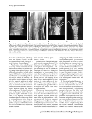 dial volar to ulnar dorsal. Other op-
tions for styloid ﬁxation include
percutaneous lag screw ﬁxation or a
small buttress plate and pins.20
Plate ﬁxation of the radial styloid
is usually done in combination with
stabilization of medial column inju-
ries of the distal radius. Volar or dor-
sal distal radius plates include radial
styloid stabilization in their construct
and therefore do not need separate ra-
dial styloid plating or pinning. Cer-
tain smaller implant designs are avail-
able for separate plating of radial
styloid fractures, but this is almost al-
ways in combination with medial col-
umn stabilization (whether dorsal or
volar). Separate lateral and medial
column plating of the distal radius is
most mechanically stable when the
plates are angled 50° to 90° to each
other.11,17,20,21 Separate radial styloid
plates are placed on the dorsal radial
or most radial aspect of the distal ra-
dius; this placement requires a low-
proﬁle design to avoid irritation of the
brachioradialis tendon or dorsal ex-
tensor tendons.
Intra-articular Fractures of the
Medial Column
Unstable volar fractures are ame-
nable to volar plate stabilization. If the
fracture is isolated (ie, there is no dor-
sal fragment instability), then a sim-
ple buttress plate may be used to re-
constitute the volar cortex. If the volar
metaphysis is comminuted, bone
void ﬁller may be used to ﬁll in the
gap and also to support the distal ar-
ticular surface. The integrity of the
joint should not be violated by dis-
secting the volar radiocarpal liga-
ments. When necessary, the volar cor-
tex can be hinged open like a book
to inspect and realign volar intra-
articular injuries.
When dorsal fragment instability
also is present, several options are
available. If a volar buttress plate has
been applied, then the dorsal frag-
ment must be stabilized from a dor-
sal approach. If the dorsal fragment
is large, it can be ﬁxed by one or (pref-
erably) two percutaneous cross pins
entering the dorsal medial fragment
distally and aimed proximally and ra-
dially (Figs. 8 and 9). As with the ra-
dial styloid fragment, percutaneous
pins can be used as joysticks to ma-
nipulate the dorsal fragment into po-
sition. The pins also may be placed
into the fracture line (intrafocal Ka-
pandji pinning [Fig. 10]), starting
more perpendicular to the dorsal cor-
tex, and then used to reduce the dor-
sal fragment by moving the pins more
nearly parallel to the dorsal cortex,
with subsequent ﬁxation into the
volar cortex.
If the dorsal medial fragment is
comminuted, reducing and holding
the area with pin ﬁxation may be dif-
ﬁcult. The fracture can be opened dor-
sally, usually through a longitudinal
approach between the third and
fourth dorsal extensor compartments.
An approach ulnar to the fourth com-
partment also may be used if the com-
minution is limited to the dorsal ul-
nar corner and semilunar notch. The
ﬂoor of the third extensor compart-
ment is incised longitudinally; then
the fourth extensor compartment
(sheath and tendons) is sharply ele-
Figure 9 Same patient as in Figure 8. Anteroposterior (A) and lateral (B) radiographs made 1 week after injury. The laterally displaced
radial styloid fragment and volarly displaced volar medial fragment (arrows) are evident. Instability of these fragments is easily demon-
strated by their inability to maintain initial closed reduction. Anteroposterior (C) and lateral (D) postoperative radiographs show that the
volar medial fragment is stabilized with a volar plate. The radial styloid is ﬁxed with two percutaneous pins; the dorsal cortex with its large
dorsal fragments is stabilized with a dorsal percutaneous pin. The ulnar styloid also was stabilized because of the fracture through its base,
marked displacement (>2 mm), and clinical instability of the DRUJ after stabilization of the distal radius. (Courtesy of David M. Lichtman,
MD, Fort Worth, TX.)
Plating of the Distal Radius
166 Journal of the American Academy of Orthopaedic Surgeons
 