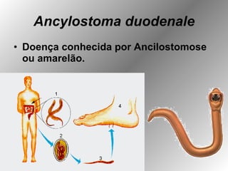 Ancylostoma duodenale Doença conhecida por Ancilostomose ou amarelão. 
