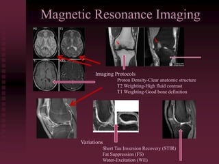 Magnetic Resonance Imaging
Imaging Protocols
Proton Density-Clear anatomic structure
T2 Weighting-High fluid contrast
T1 Weighting-Good bone definition
Variations
Short Tau Inversion Recovery (STIR)
Fat Suppression (FS)
Water-Excitation (WE)
 
