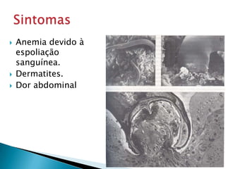  Anemia devido à
espoliação
sanguínea.
 Dermatites.
 Dor abdominal
 